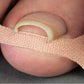 Nail Pain Relief Bandage